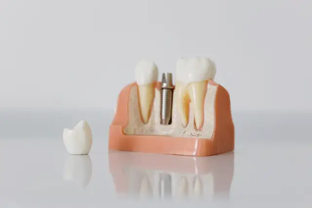 Model showing an implant, crown and natural teeth